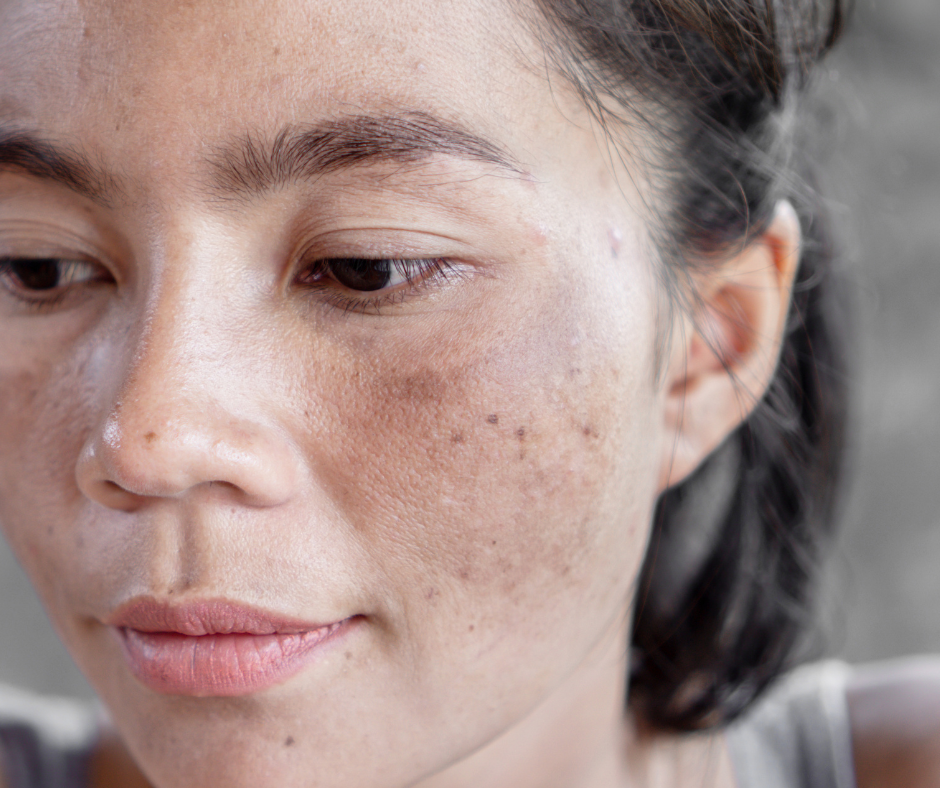 Sun Damage - SRGN Clinic