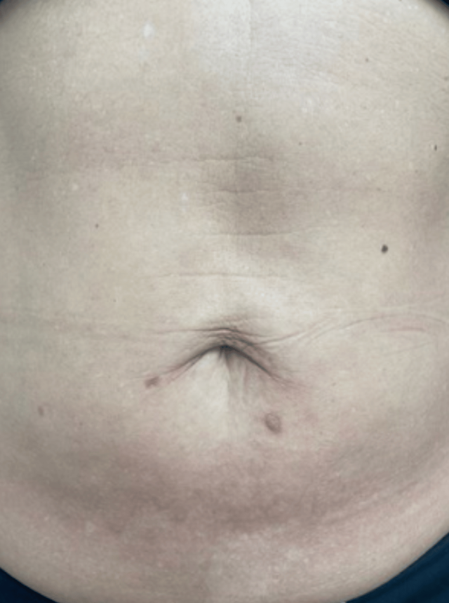 skin tightening after image