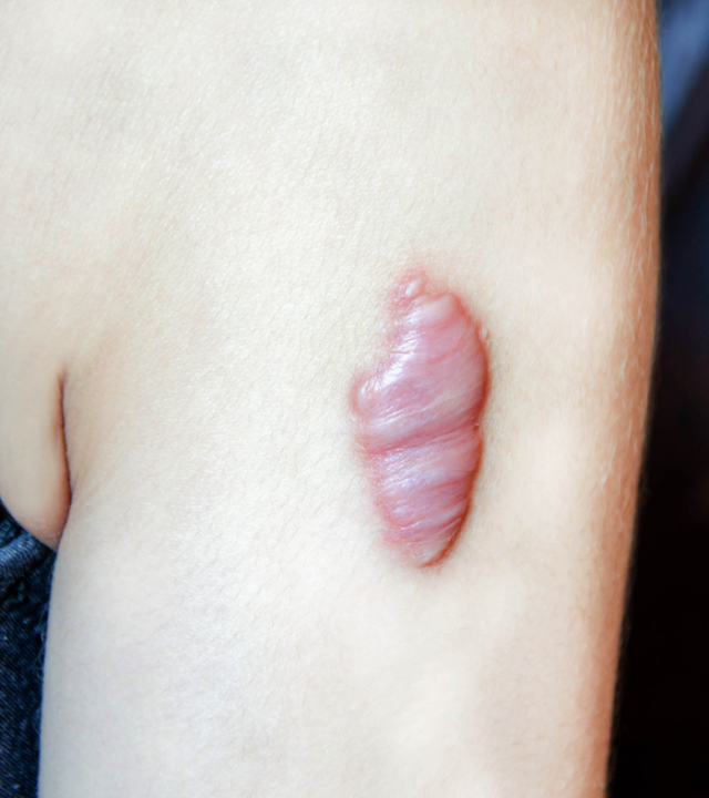 Is It Worth Getting a Scar Revision?