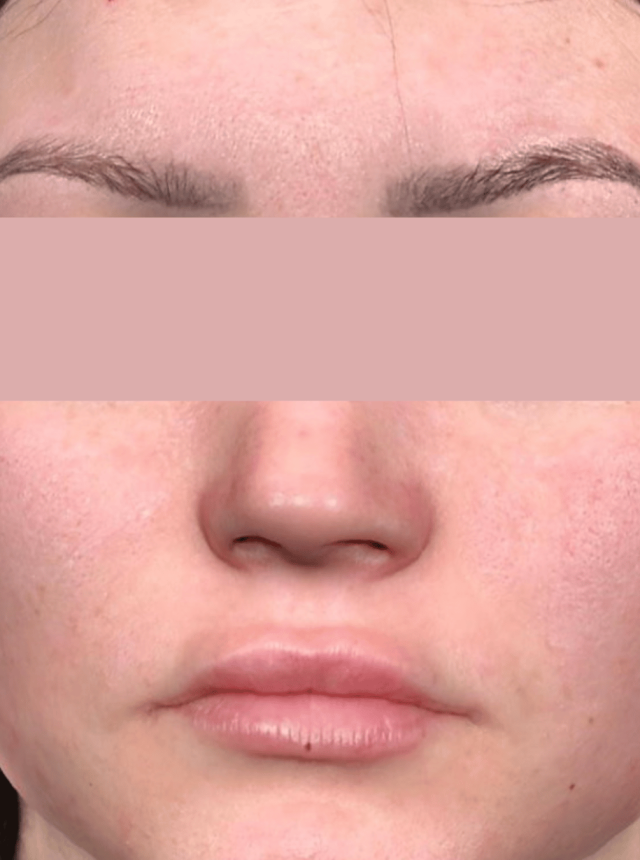 coolpeel laser after
