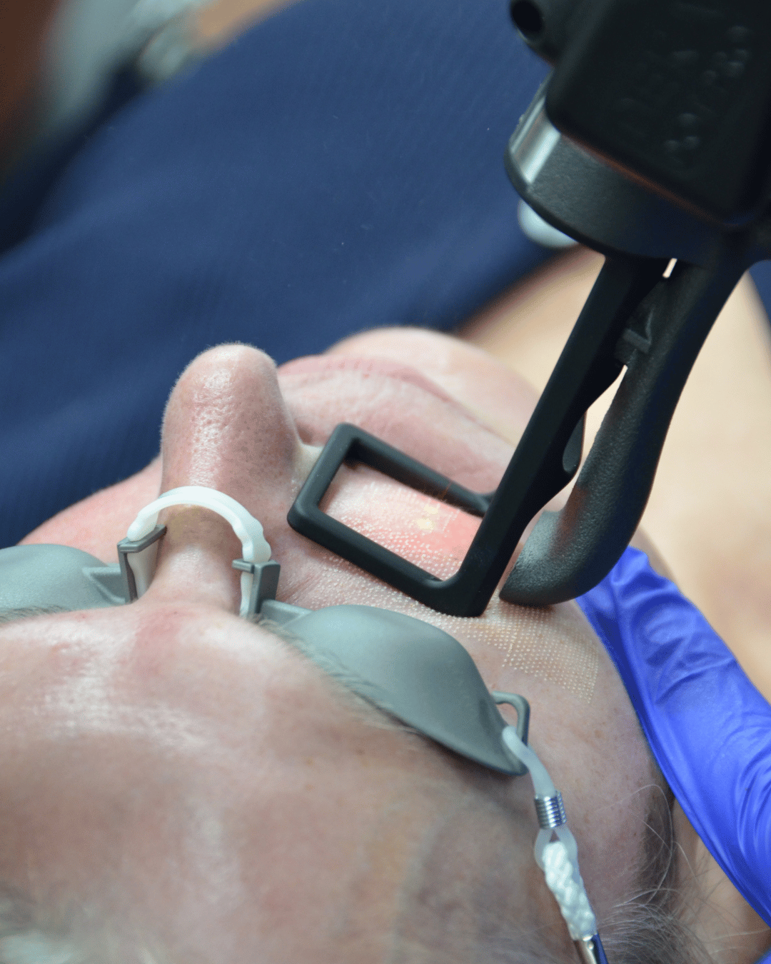 co2 fractional laser tightening