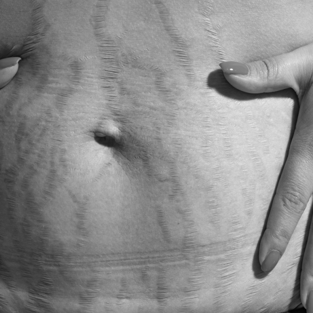 stretch marks from pregnancy