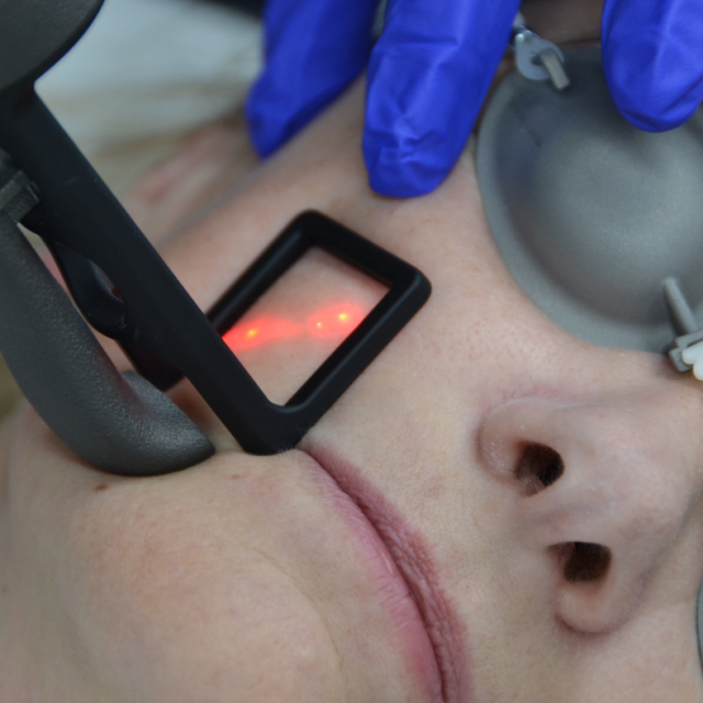 CoolPeel Laser