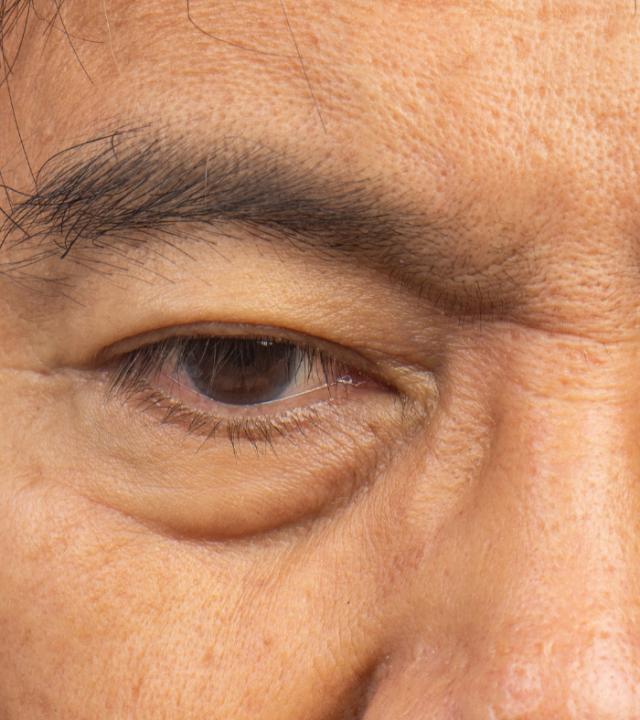 How to Get Rid of Hooded Eyes (Asian)?