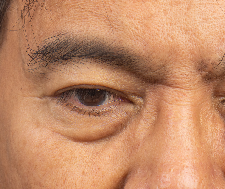 How to Get Rid of Hooded Eyes (Asian)?