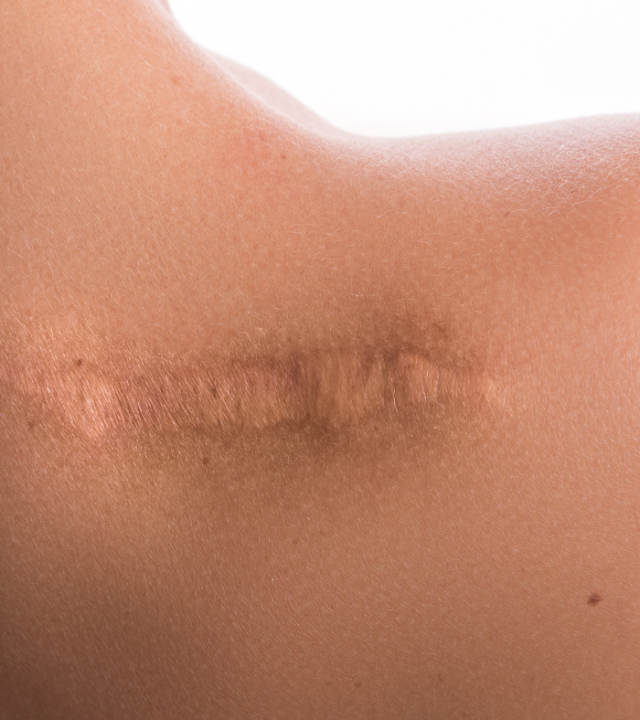 Does CO2 Laser Help With Scarring?