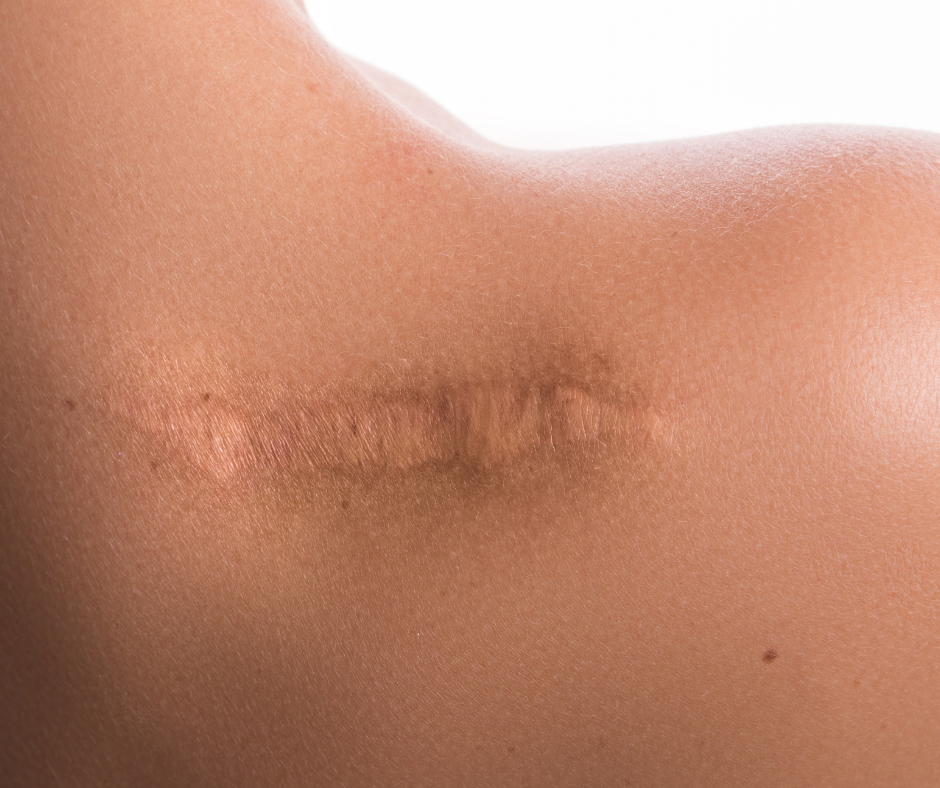 Does CO2 Laser Help With Scarring?