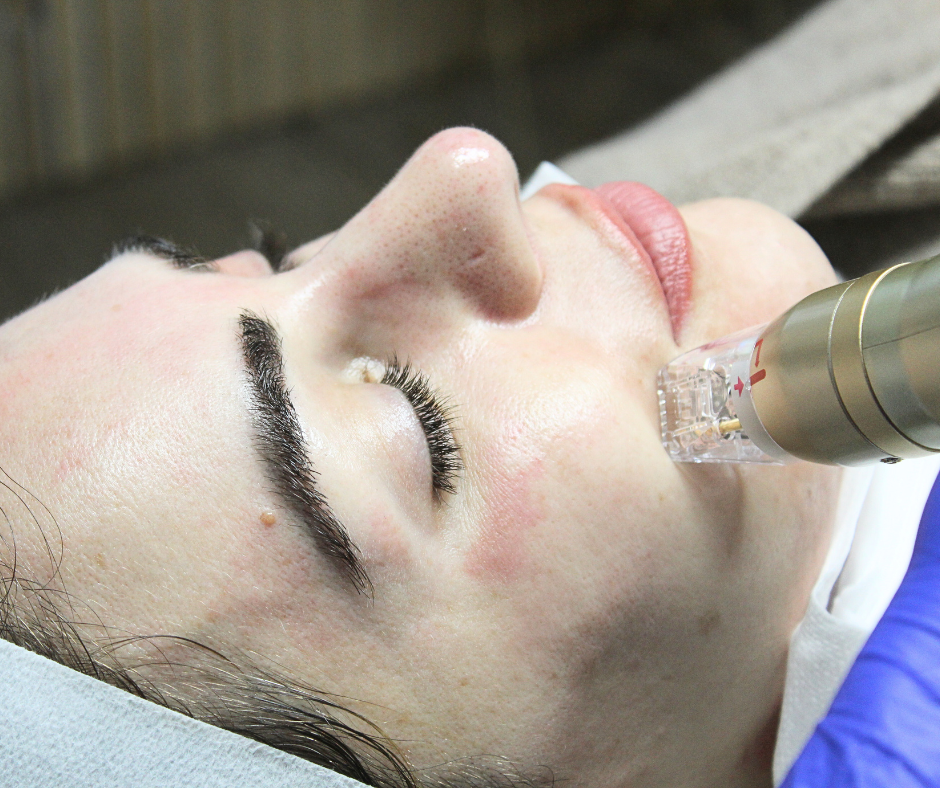 Which is better, Morpheus8 or Sylfirm X?