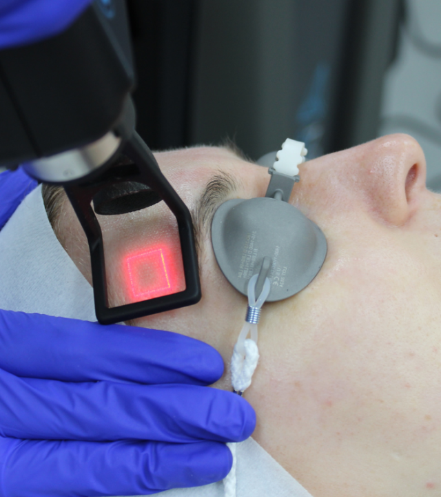 Does CoolPeel laser really work?