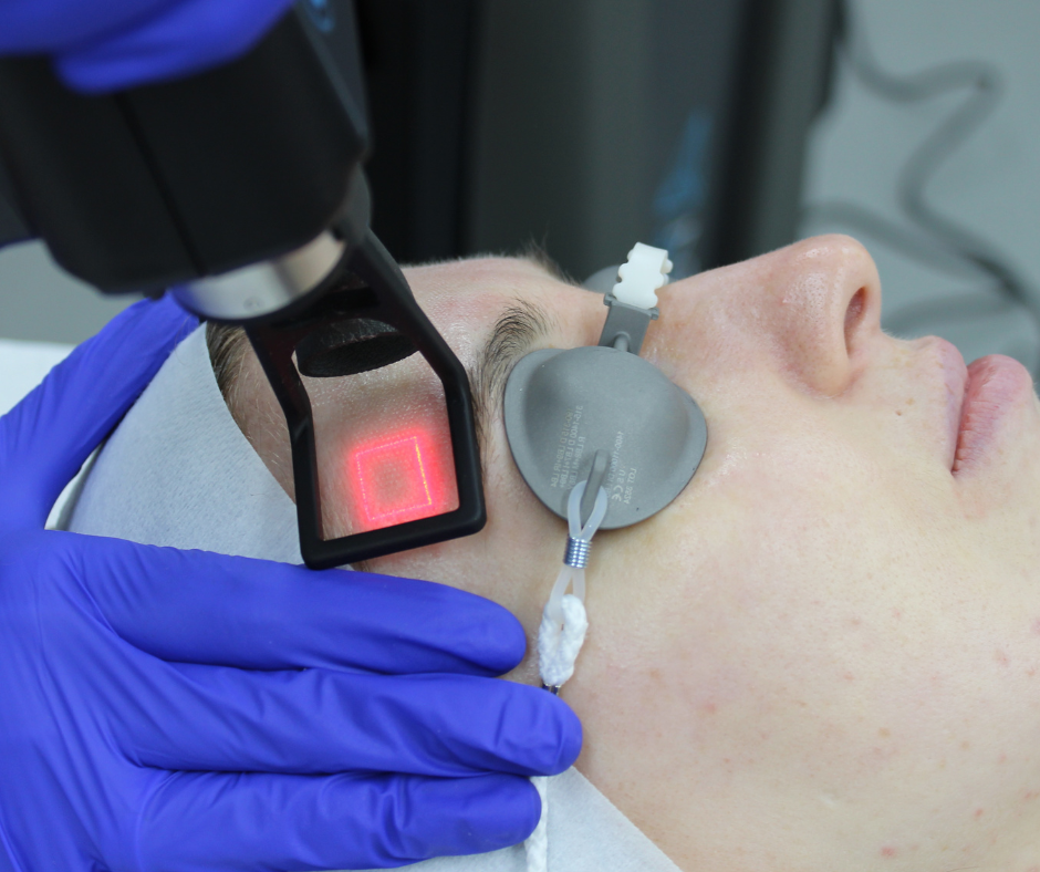 Does CoolPeel laser really work?