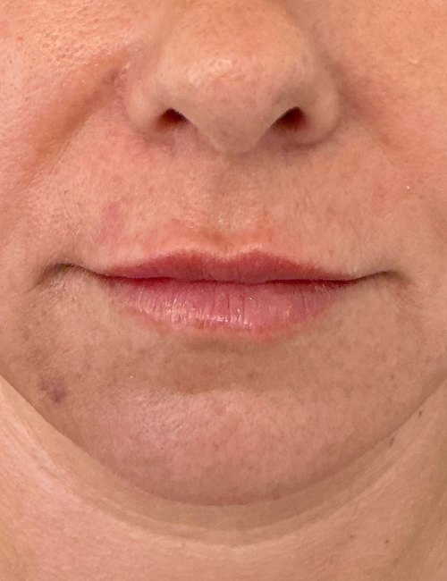 dr victoria lips after