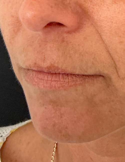 thin lips before filler