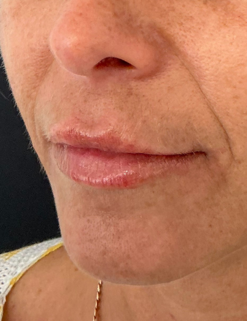 thin lips after filler