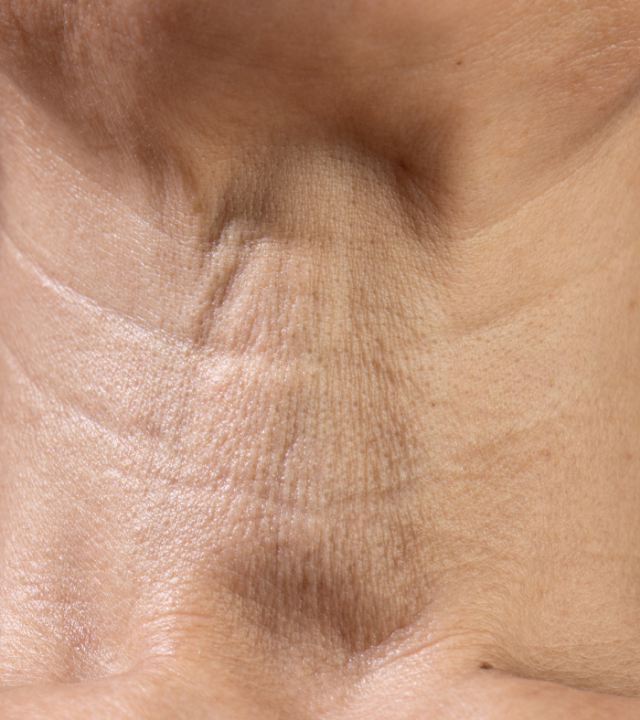 What Is the Best Way to Tighten Neck Skin?