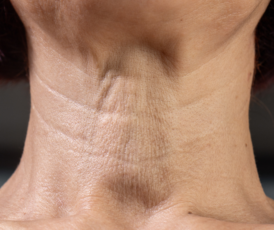 What Is the Best Way to Tighten Neck Skin?