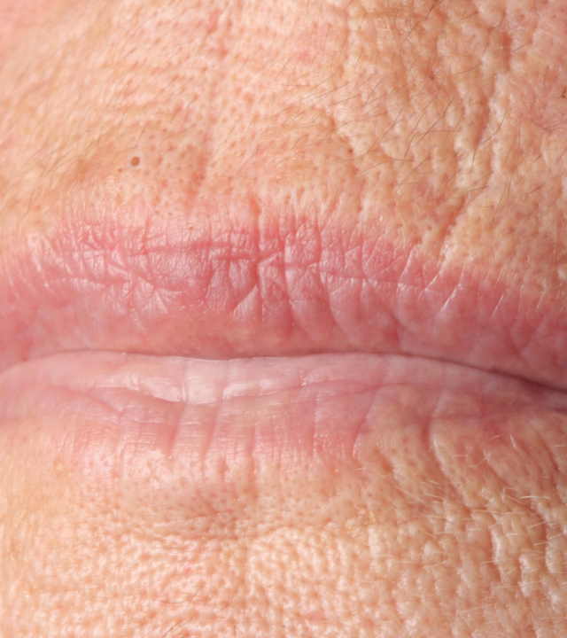 Can heat dissolve fillers?