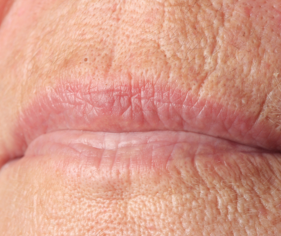 Can heat dissolve fillers?