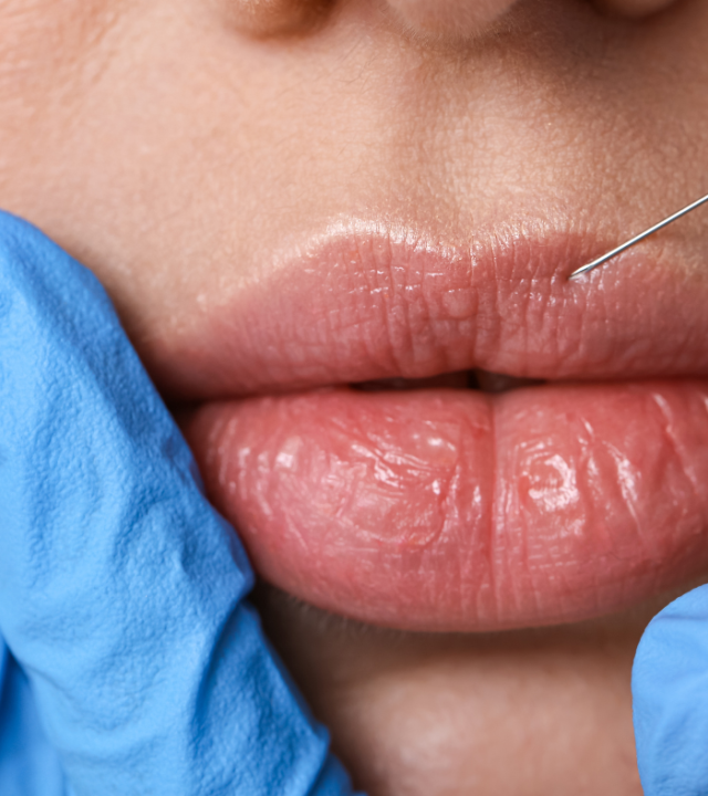 Can you have lip fillers on very thin lips?
