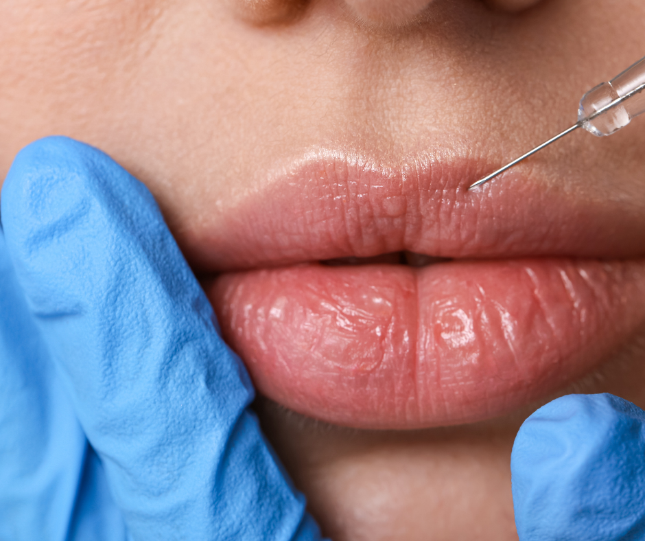Can you have lip fillers on very thin lips?