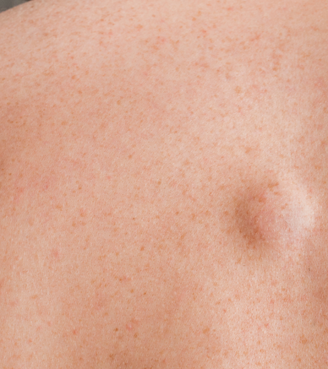 lipoma lump in patients back