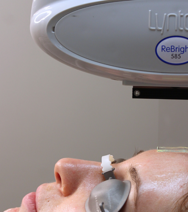 Should You Pause Laser Treatments for Summer