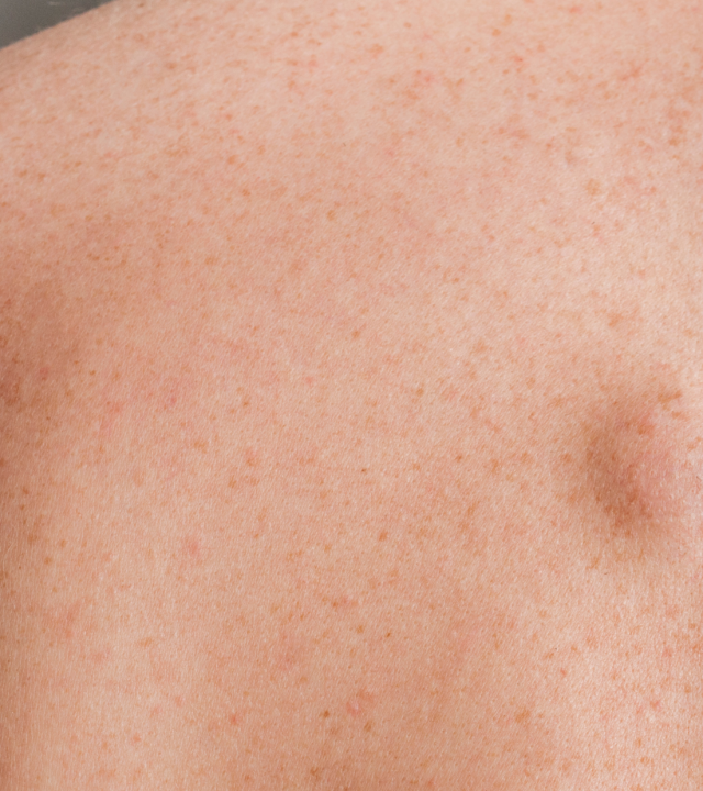 body lipoma on mans back