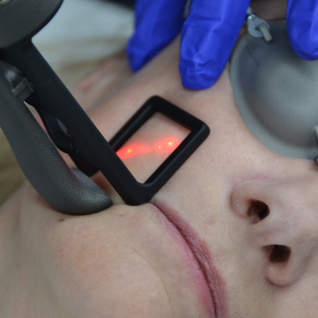 CoolPeel Laser