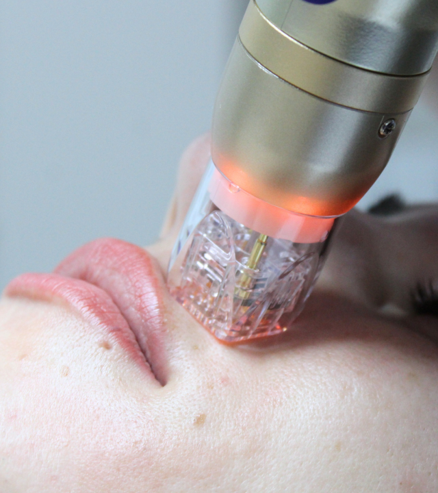 skin tightening with sylfirm x