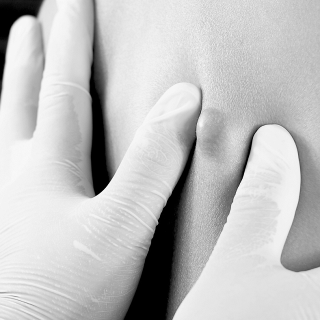 lipoma removal in clinic