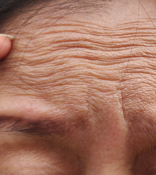 Does CO2 Laser Remove Forehead Wrinkles?