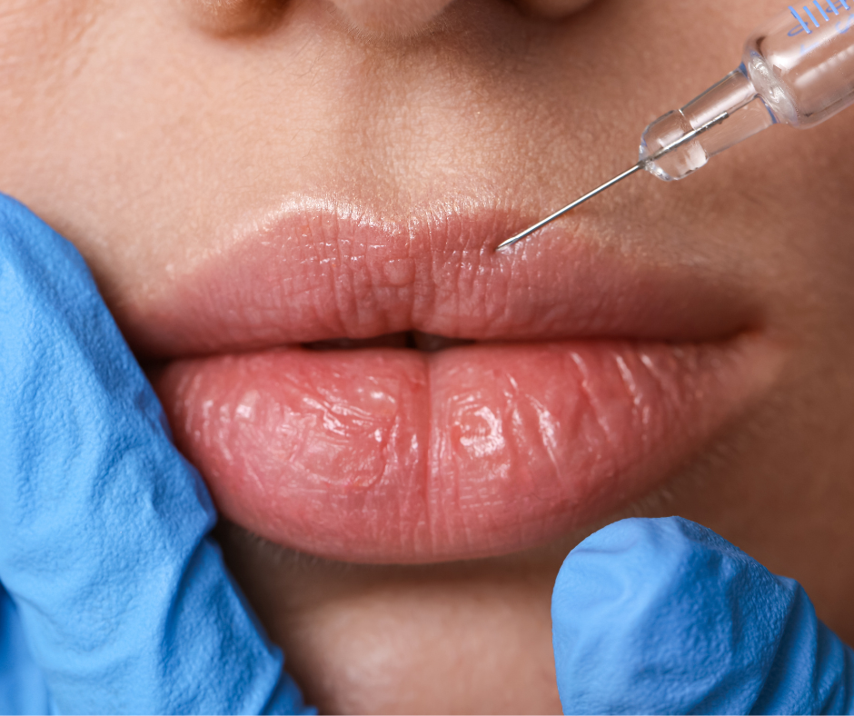 Can You Feel Lip Fillers When Kissing?