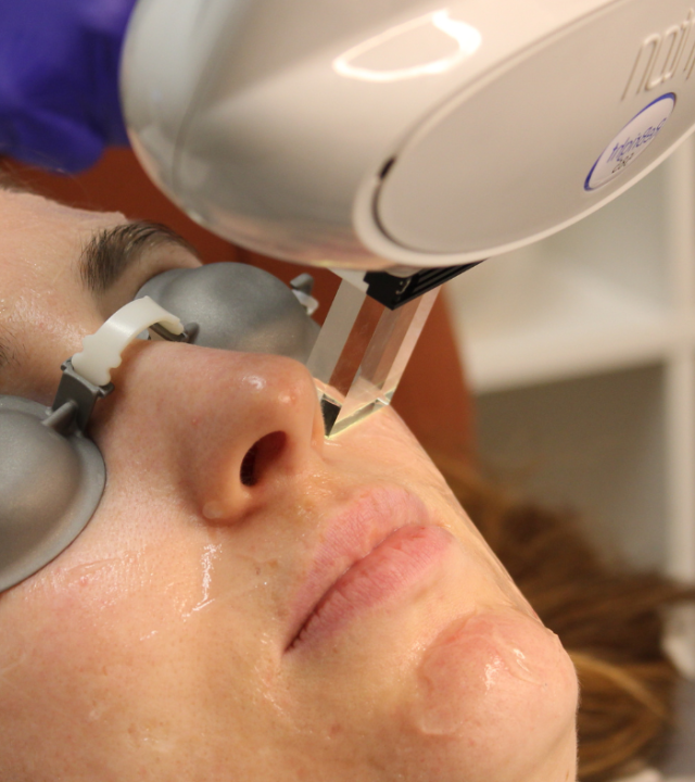 Is Microneedling or IPL Better for Rosacea?