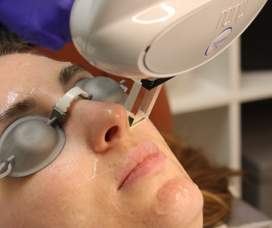 Is Microneedling or IPL Better for Rosacea?