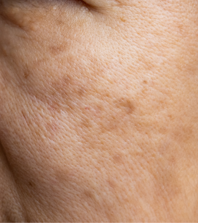 What Triggers Skin Pigmentation?