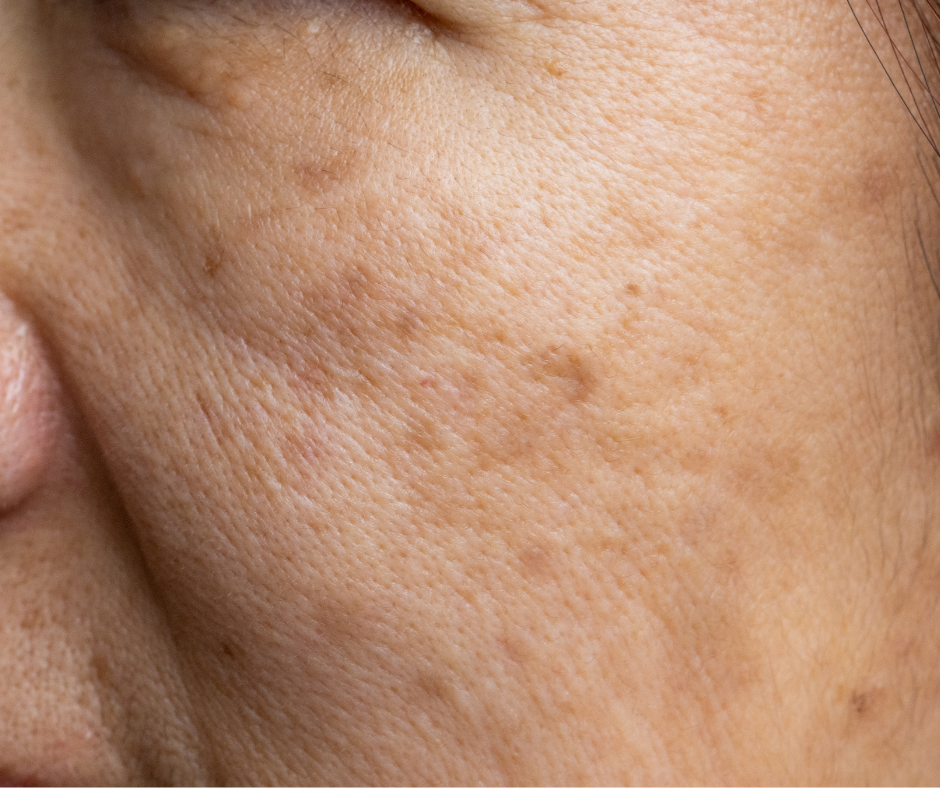 What Triggers Skin Pigmentation?