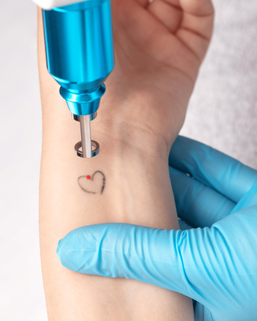 wrist tattoo removal