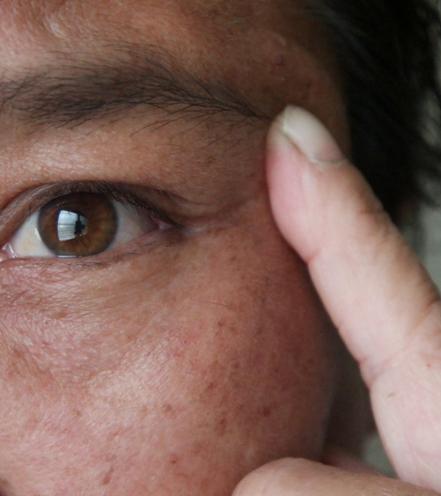 Can Facial Sun Damage Be Repaired?