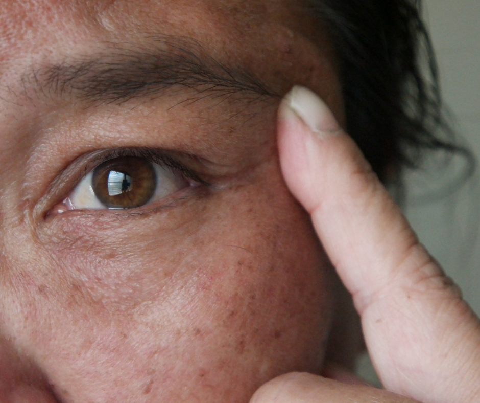 Can Facial Sun Damage Be Repaired?