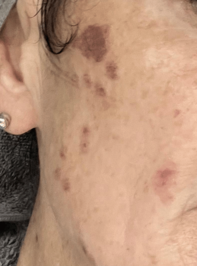 pigmentation on the face