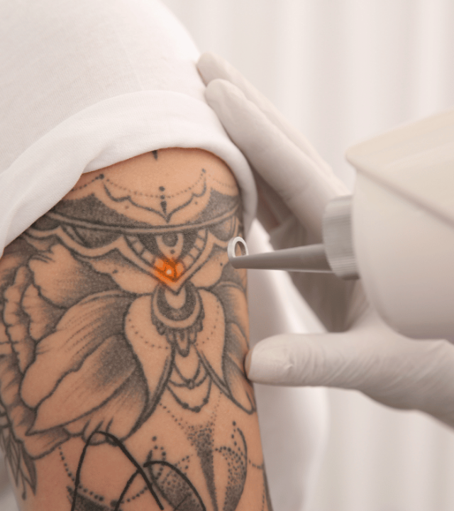 laser tattoo removal with pico