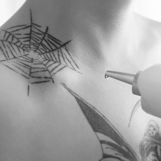 removing chest tattoo