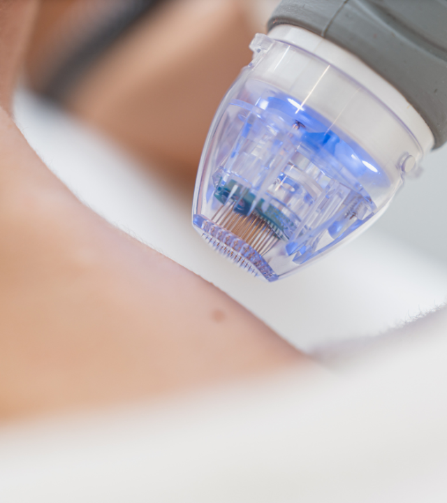 Which Is Better, Morpheus8 or RF Microneedling?