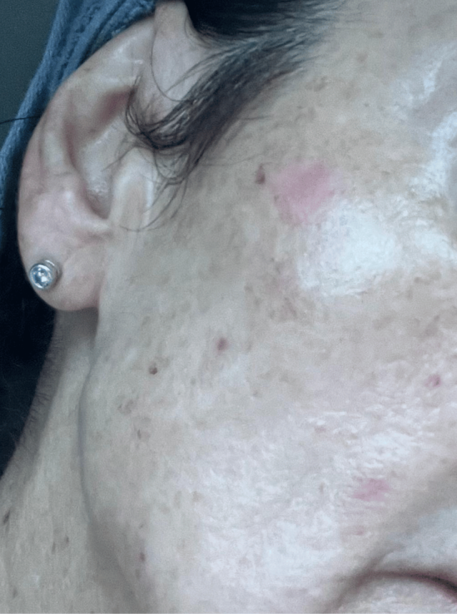 pigmentation removed from the face