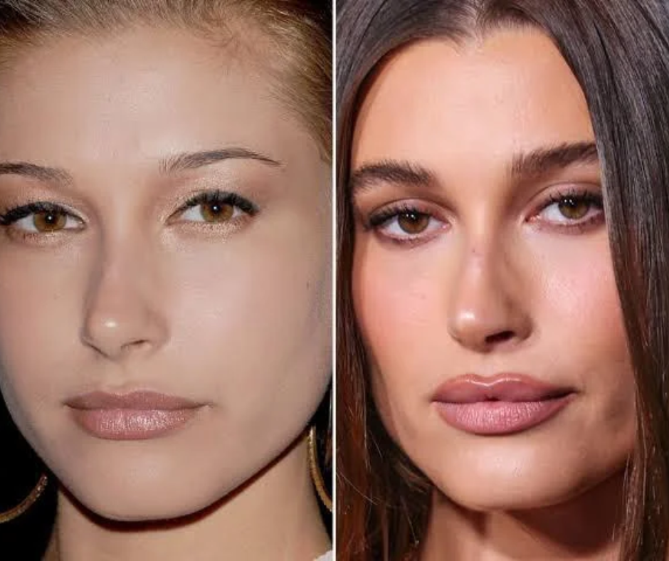 Do Most Celebrities Get Blepharoplasty?