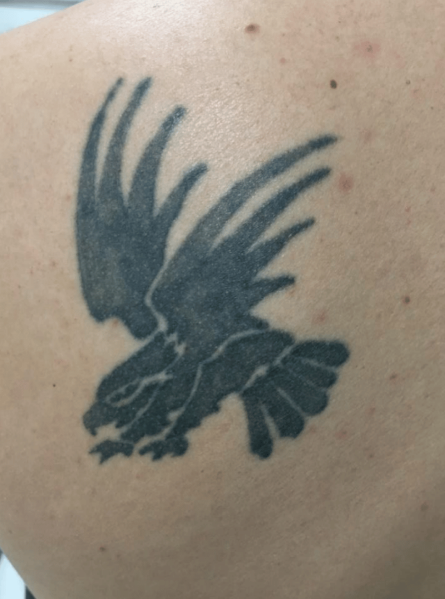 back tattoo before treatment