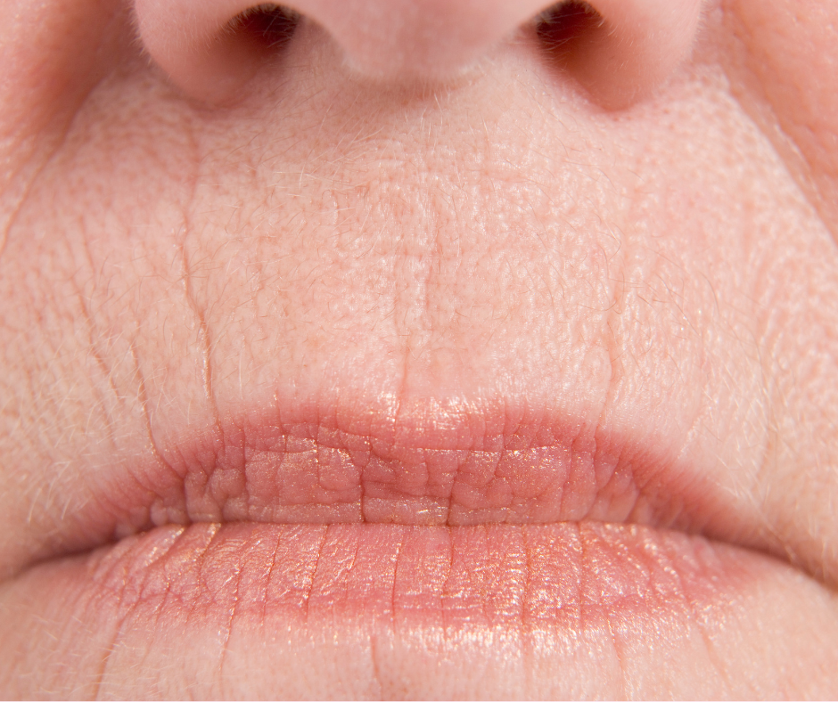 How Can I Reverse the Ageing Around My Mouth?