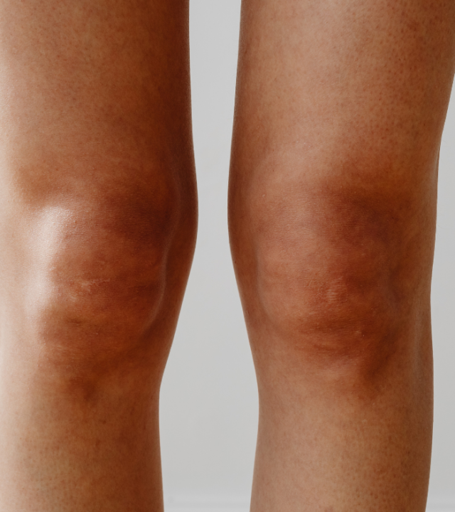 How to get rid of hyperpigmentation on knees?