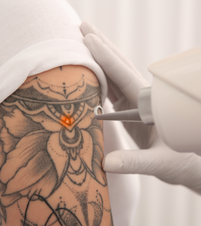 Can tattoos be completely removed with laser?