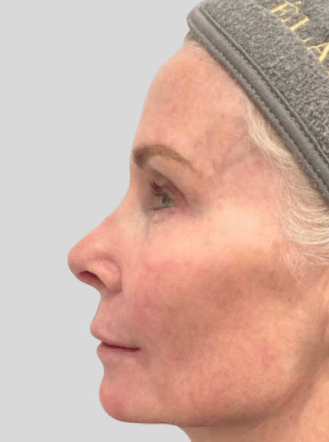 coolpeel tetra after