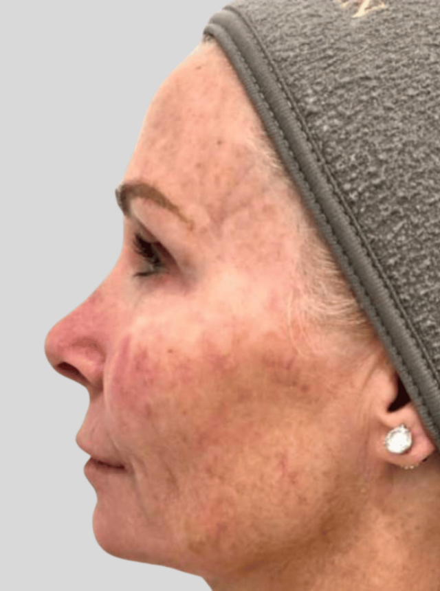 coolpeel tetra before